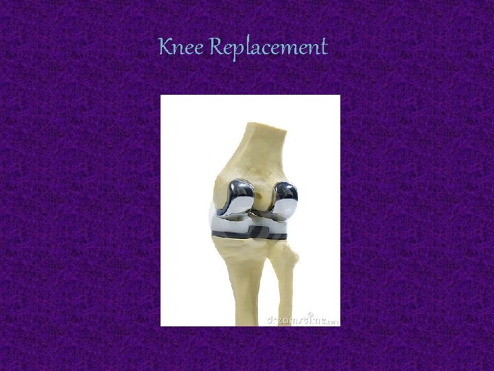 Knee Replacement 