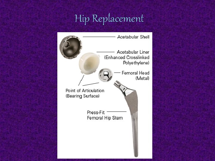 Hip Replacement 