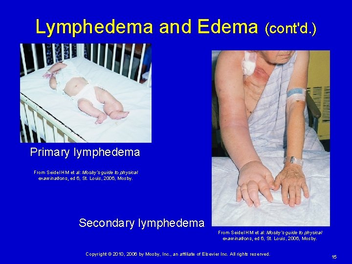 Lymphedema and Edema (cont'd. ) Primary lymphedema From Seidel HM et al: Mosby’s guide