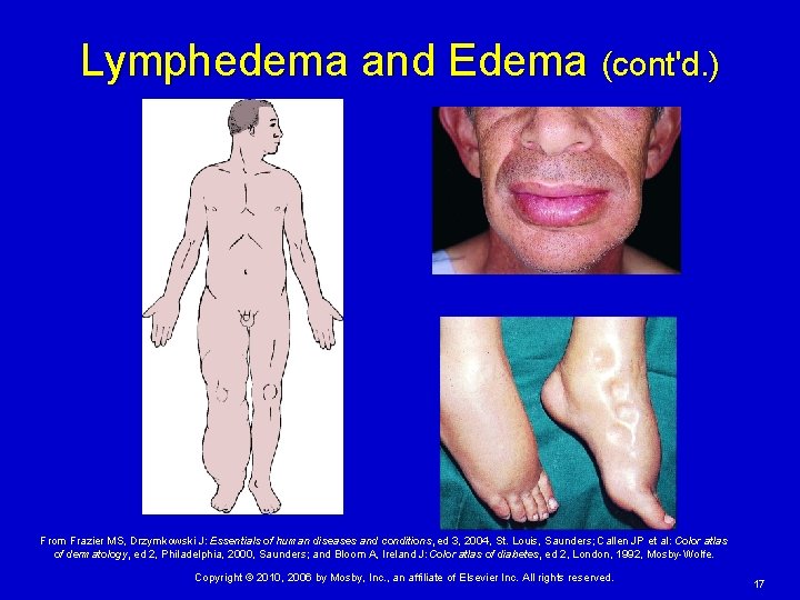 Lymphedema and Edema (cont'd. ) From Frazier MS, Drzymkowski J: Essentials of human diseases