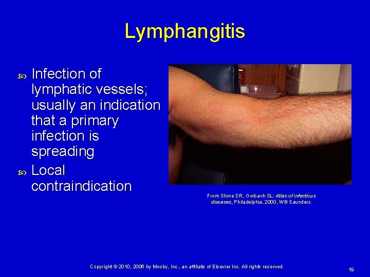 Lymphangitis Infection of lymphatic vessels; usually an indication that a primary infection is spreading