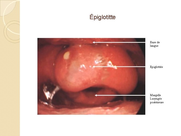 Épiglotitte 