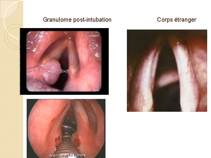 Granulome post-intubation Corps étranger 