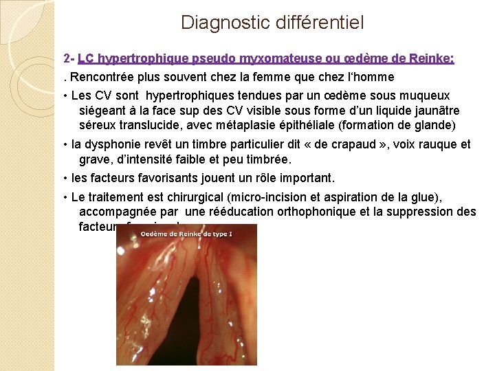 Diagnostic différentiel 2 - LC hypertrophique pseudo myxomateuse ou œdème de Reinke: . Rencontrée