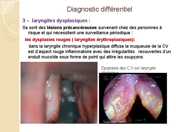 Diagnostic différentiel 3 – laryngites dysplasiques : Se sont des lésions précancéreuses survenant chez