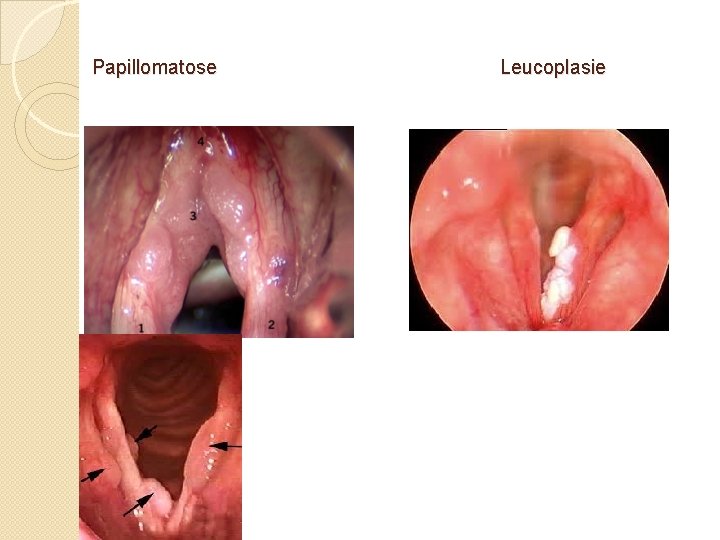 Papillomatose Leucoplasie 