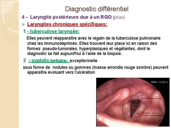 Diagnostic différentiel 4 - Laryngite postérieure due à un RGO (photo) Ø Laryngites chroniques