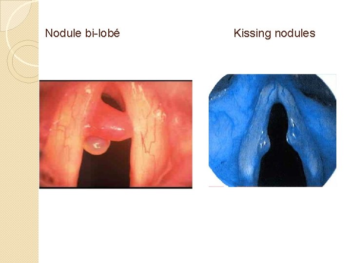 Nodule bi-lobé Kissing nodules 