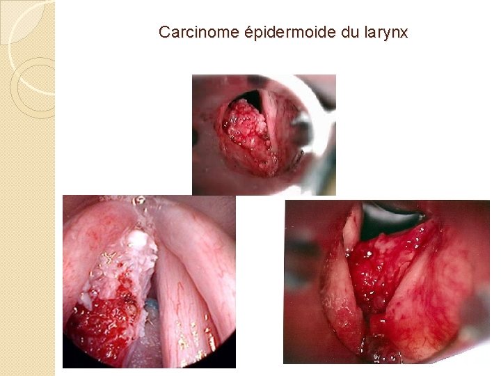 Carcinome épidermoide du larynx 