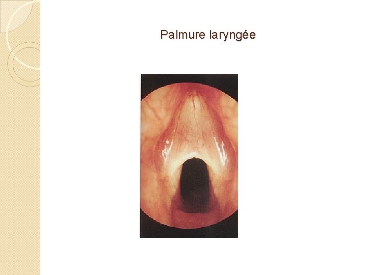 Palmure laryngée 