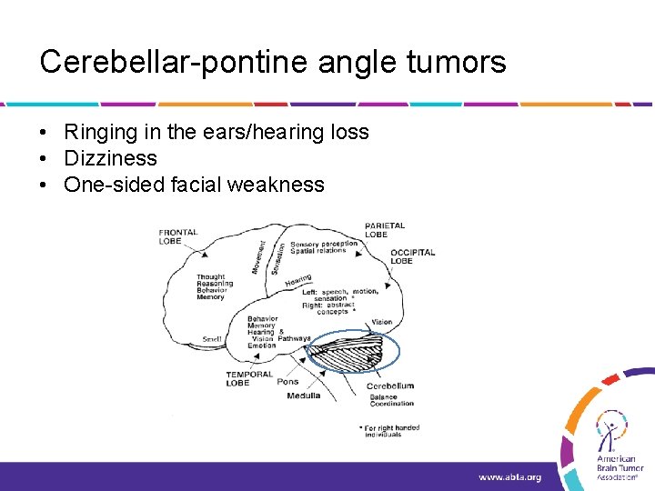 Cerebellar-pontine angle tumors • Ringing in the ears/hearing loss • Dizziness • One-sided facial
