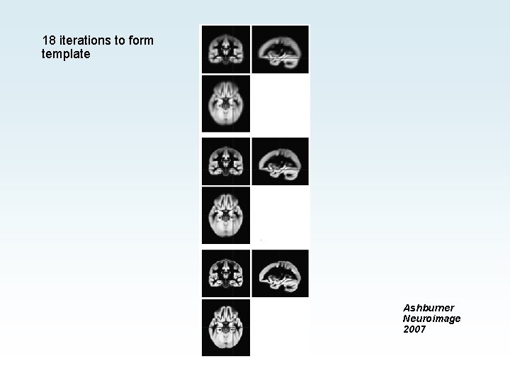 18 iterations to form template Ashburner Neuroimage 2007 