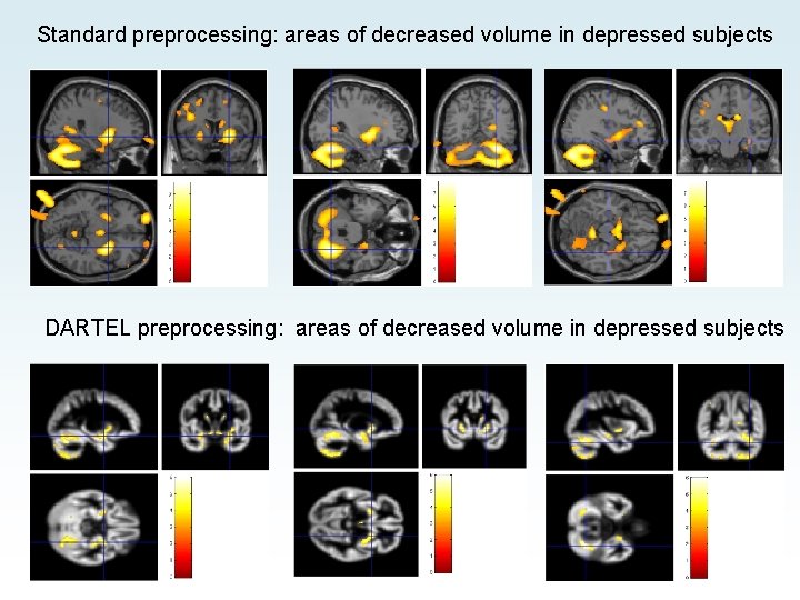Standard preprocessing: areas of decreased volume in depressed subjects DARTEL preprocessing: areas of decreased