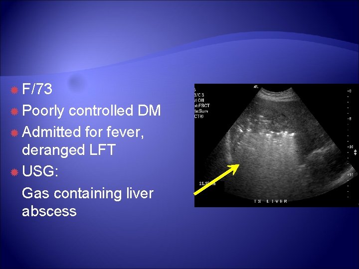 F/73 Poorly controlled DM Admitted for fever, deranged LFT USG: Gas containing liver F/73 Poorly controlled DM Admitted for fever, deranged LFT USG: Gas containing liver
