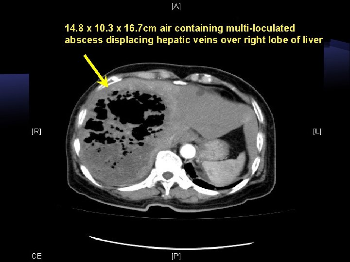 14. 8 x 10. 3 x 16. 7 cm air containing multi-loculated abscess displacing 14. 8 x 10. 3 x 16. 7 cm air containing multi-loculated abscess displacing