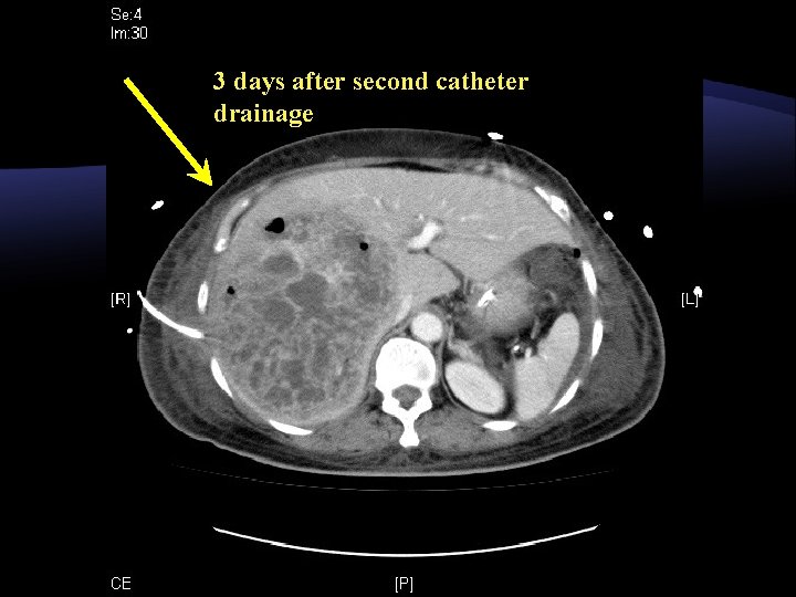 3 days after second catheter drainage 3 days after second catheter drainage