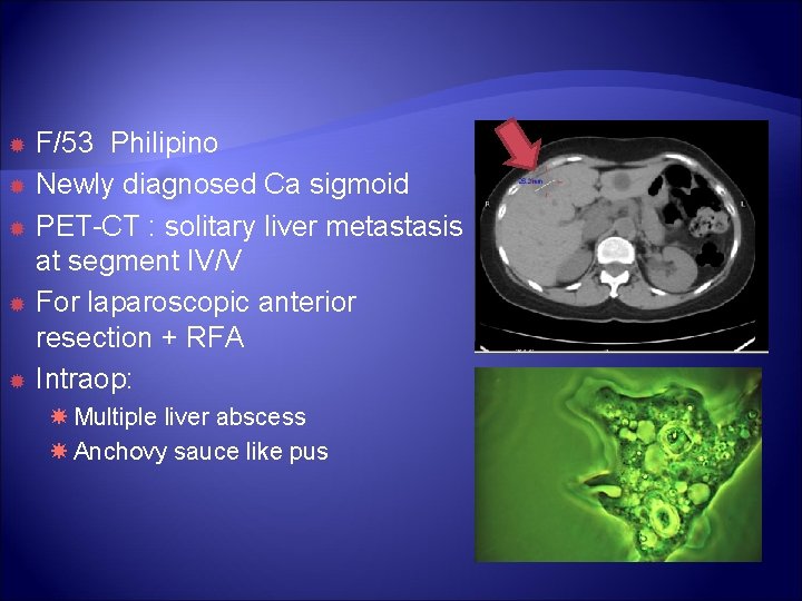 F/53 Philipino Newly diagnosed Ca sigmoid PET-CT : solitary liver metastasis at segment F/53 Philipino Newly diagnosed Ca sigmoid PET-CT : solitary liver metastasis at segment