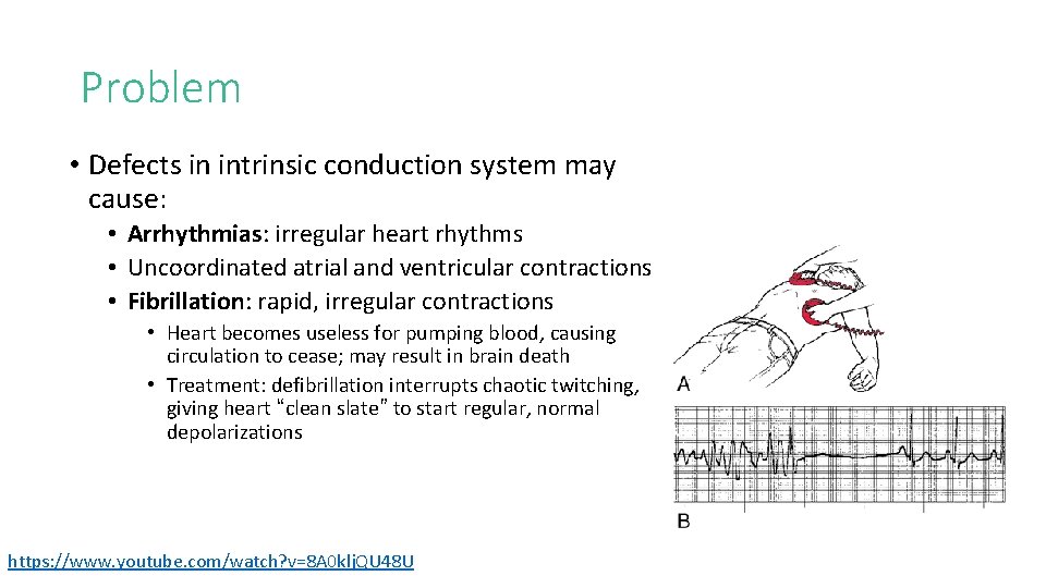 Problem • Defects in intrinsic conduction system may cause: • Arrhythmias: irregular heart rhythms