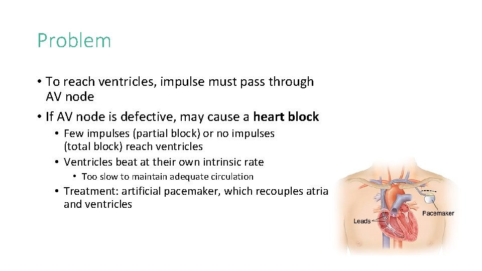 Problem • To reach ventricles, impulse must pass through AV node • If AV