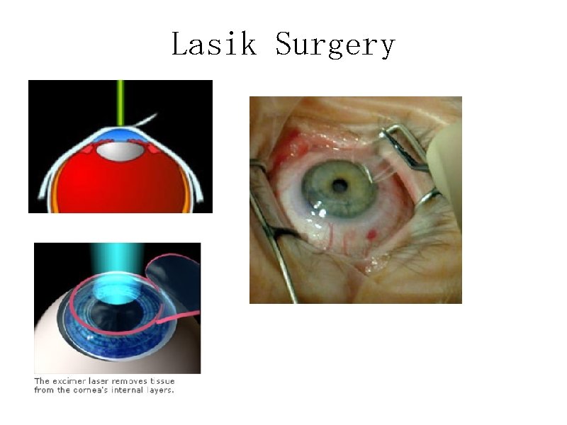 Lasik Surgery 