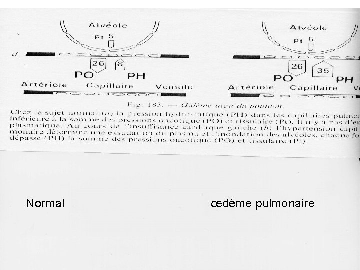 Normal œdème pulmonaire 