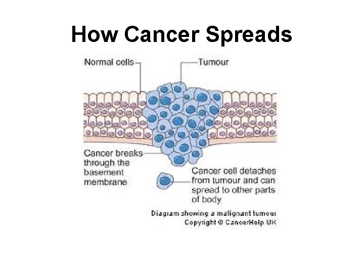 How Cancer Spreads 