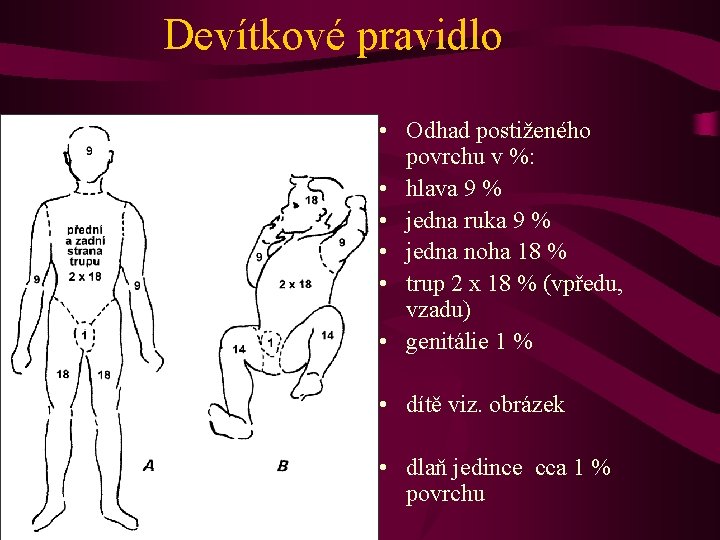 Devítkové pravidlo • Odhad postiženého povrchu v %: • hlava 9 % • jedna