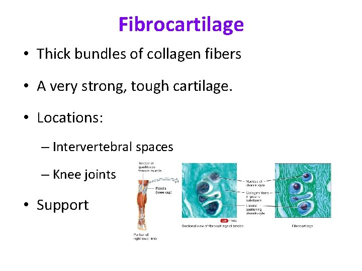 Fibrocartilage • Thick bundles of collagen fibers • A very strong, tough cartilage. •