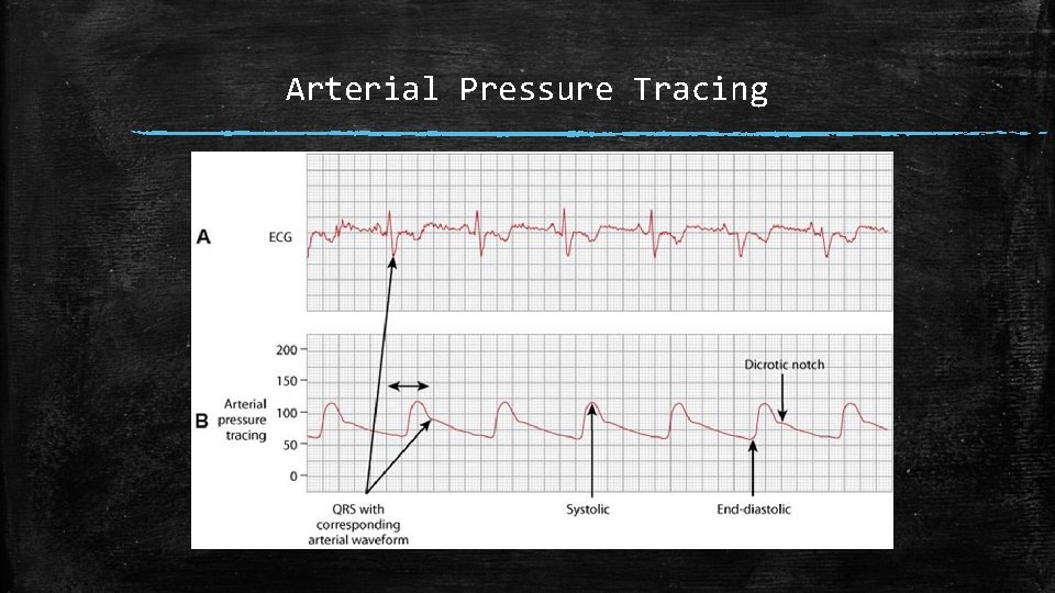 Arterial Pressure Tracing 