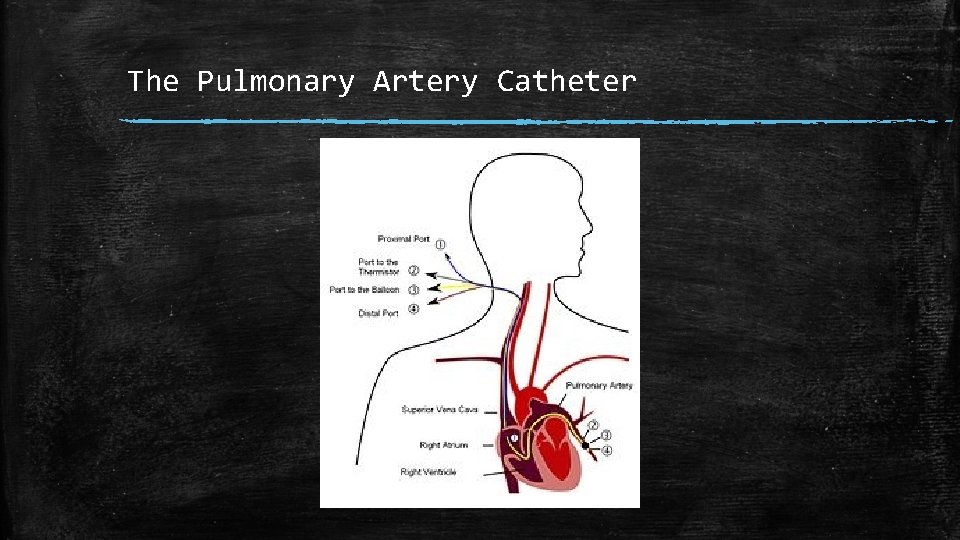 The Pulmonary Artery Catheter 