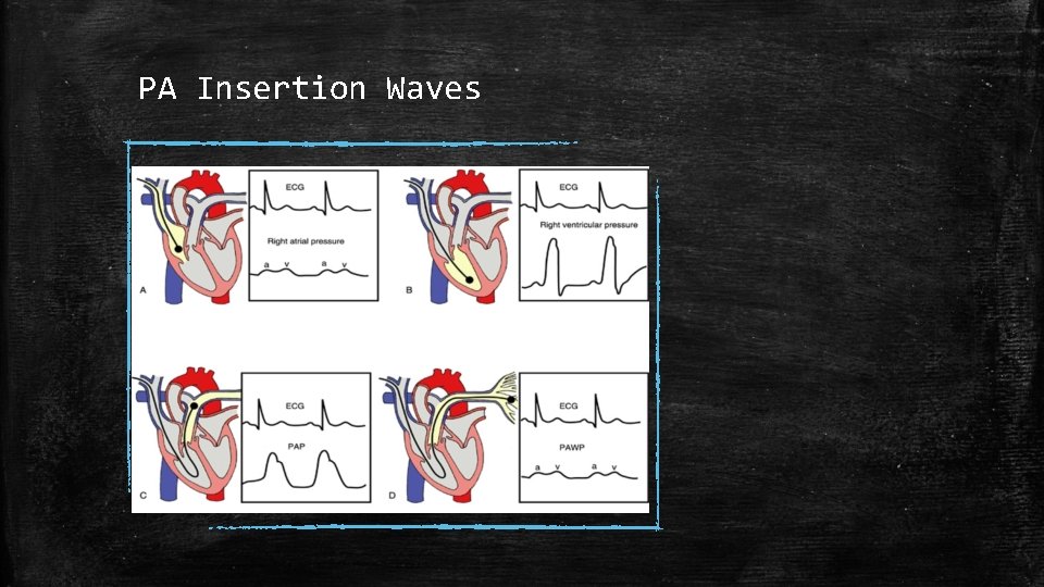 PA Insertion Waves 