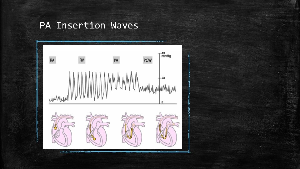 PA Insertion Waves 