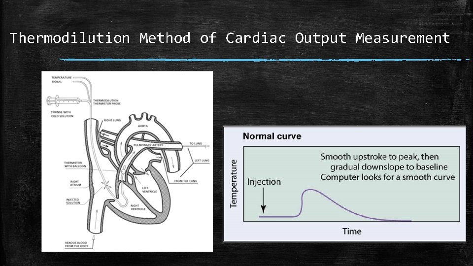 Thermodilution Method of Cardiac Output Measurement 