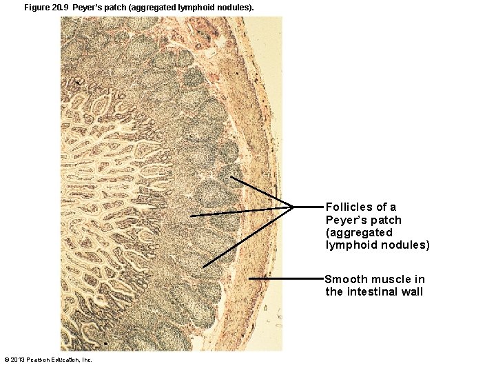 Figure 20. 9 Peyer’s patch (aggregated lymphoid nodules). Follicles of a Peyer’s patch (aggregated