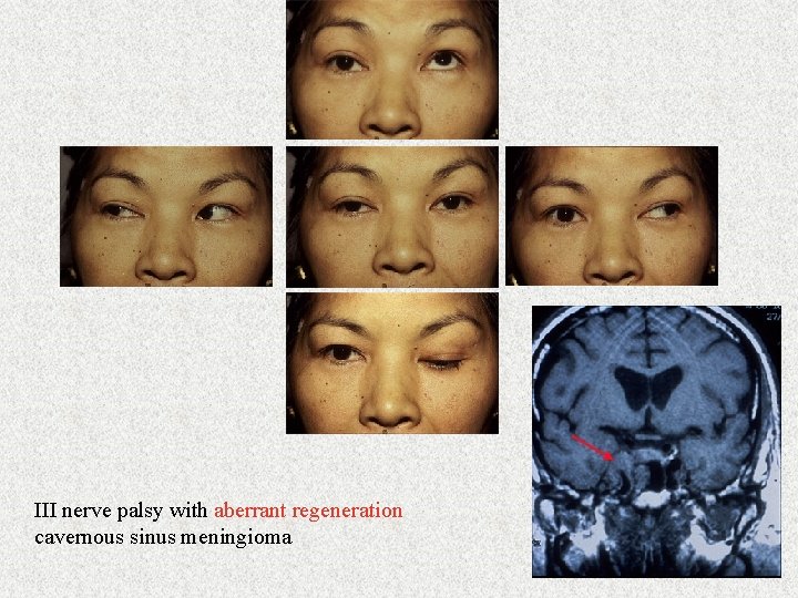 III nerve palsy with aberrant regeneration cavernous sinus meningioma 