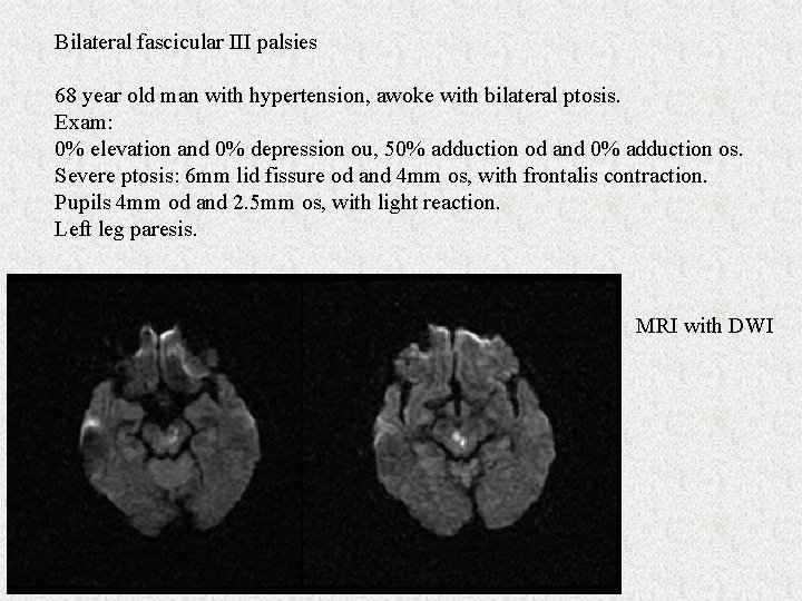 Bilateral fascicular III palsies 68 year old man with hypertension, awoke with bilateral ptosis.