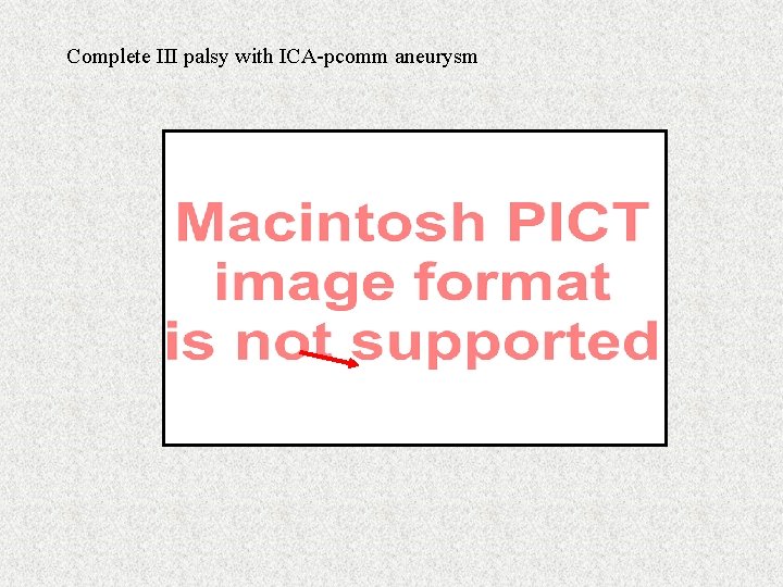 Complete III palsy with ICA-pcomm aneurysm 