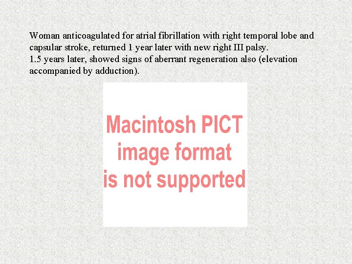 Woman anticoagulated for atrial fibrillation with right temporal lobe and capsular stroke, returned 1