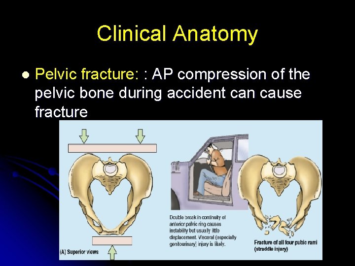 Clinical Anatomy l Pelvic fracture: : AP compression of the pelvic bone during accident
