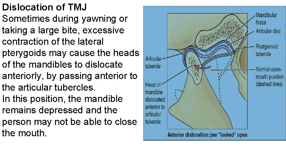 Dislocation of TMJ Sometimes during yawning or taking a large bite, excessive contraction of