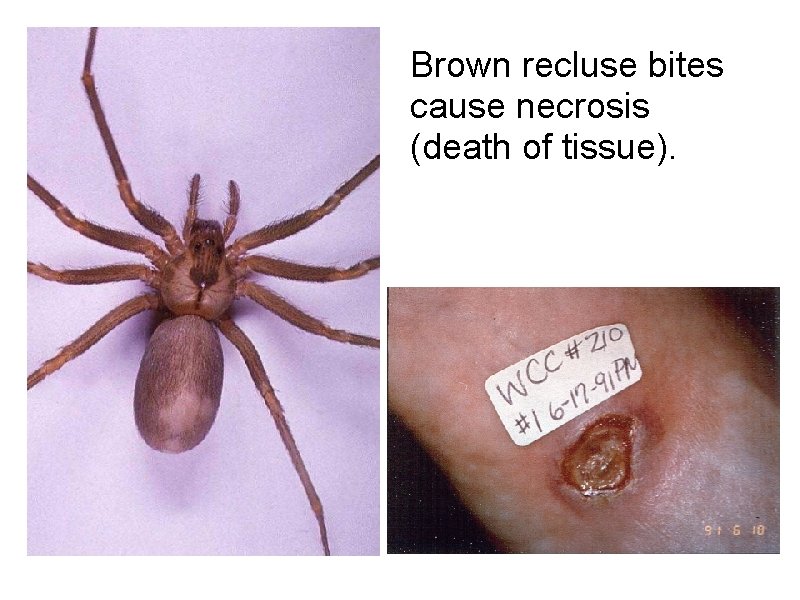 Brown recluse bites cause necrosis (death of tissue). 