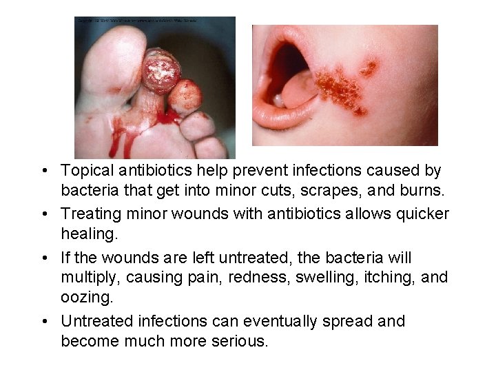  • Topical antibiotics help prevent infections caused by bacteria that get into minor