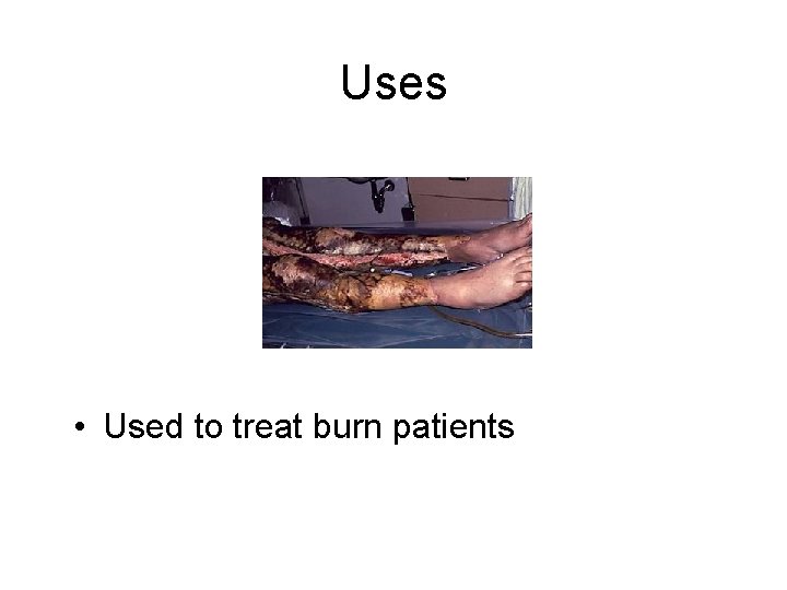 Uses • Used to treat burn patients 