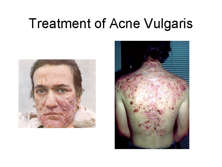 Treatment of Acne Vulgaris 