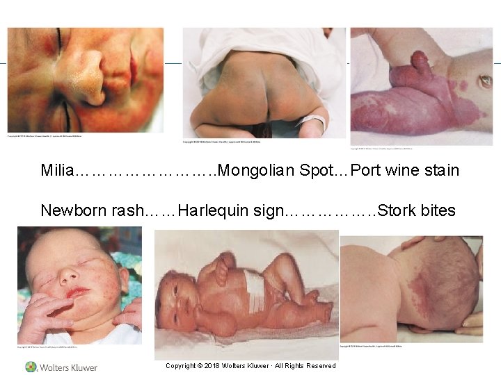 Milia…………. . Mongolian Spot…Port wine stain Newborn rash……Harlequin sign……………. . Stork bites Copyright ©