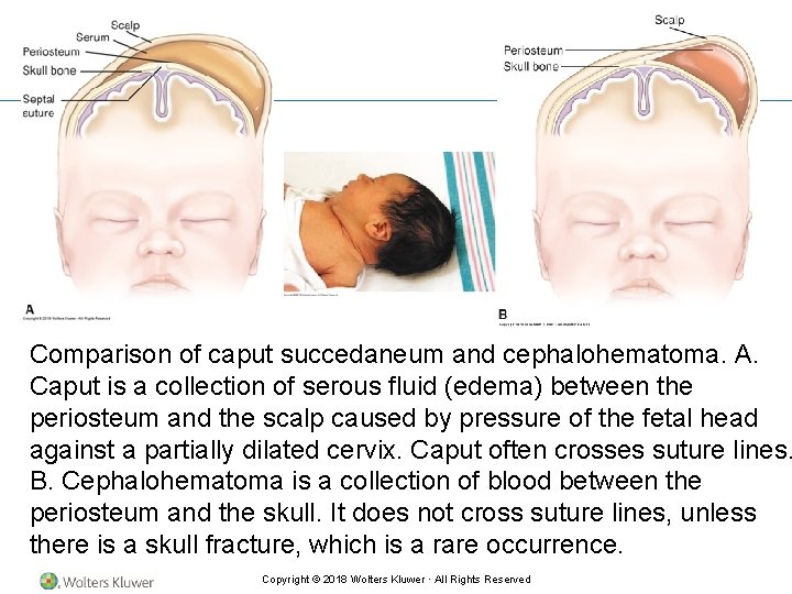Comparison of caput succedaneum and cephalohematoma. A. Caput is a collection of serous fluid