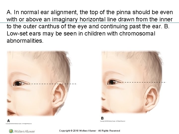 A. In normal ear alignment, the top of the pinna should be even with