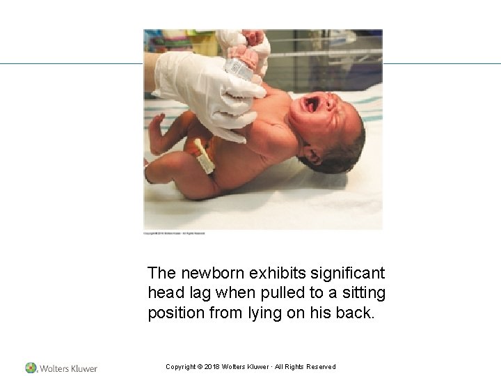 The newborn exhibits significant head lag when pulled to a sitting position from lying