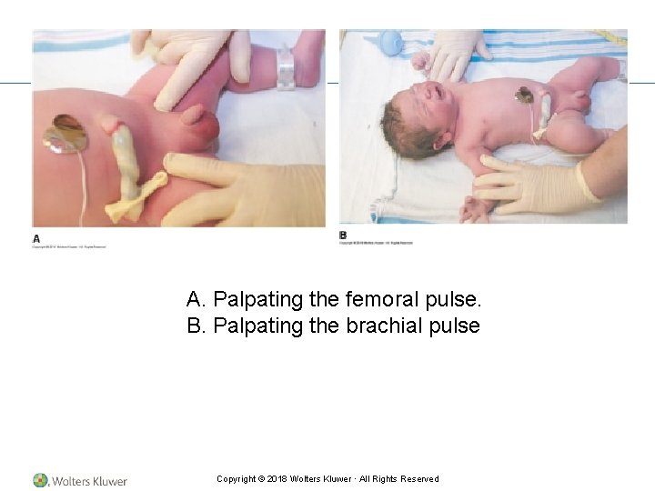 A. Palpating the femoral pulse. B. Palpating the brachial pulse Copyright © 2018 Wolters