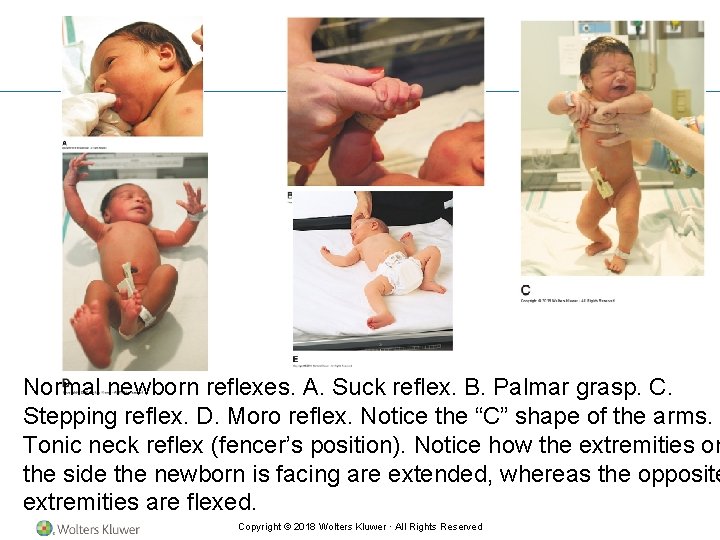 Normal newborn reflexes. A. Suck reflex. B. Palmar grasp. C. Stepping reflex. D. Moro